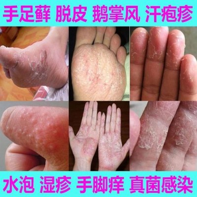 紹興手足癬_手足癬有什么表現(xiàn)_紹興治